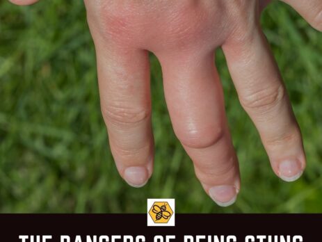 The-different-symptoms-that-come-from-a-bee-sting